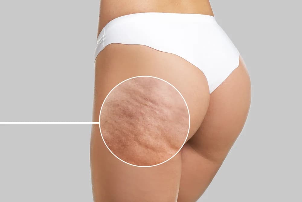 Cellulite treatment for smoother skin